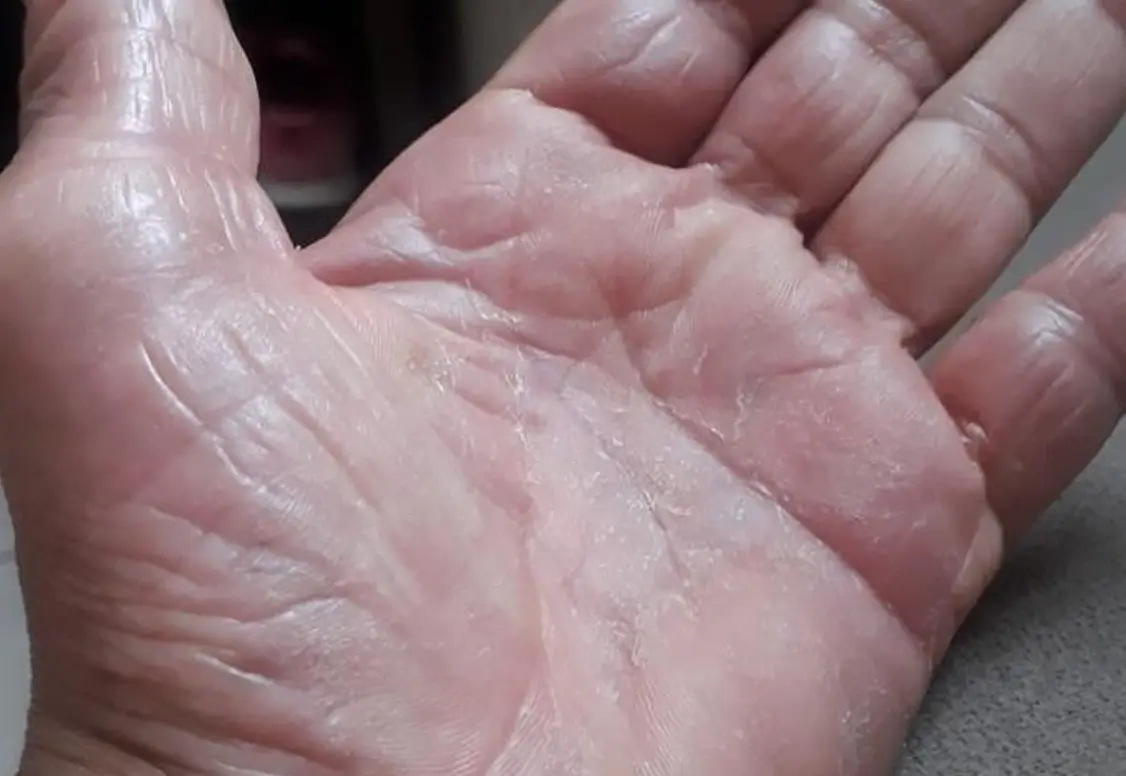 Resultado depois do tratamento